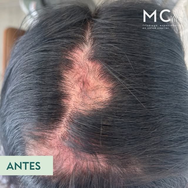 Avance en tratamiento de alopecia areata ✨

La paciente llegó a consulta con zonas de pérdida de cab