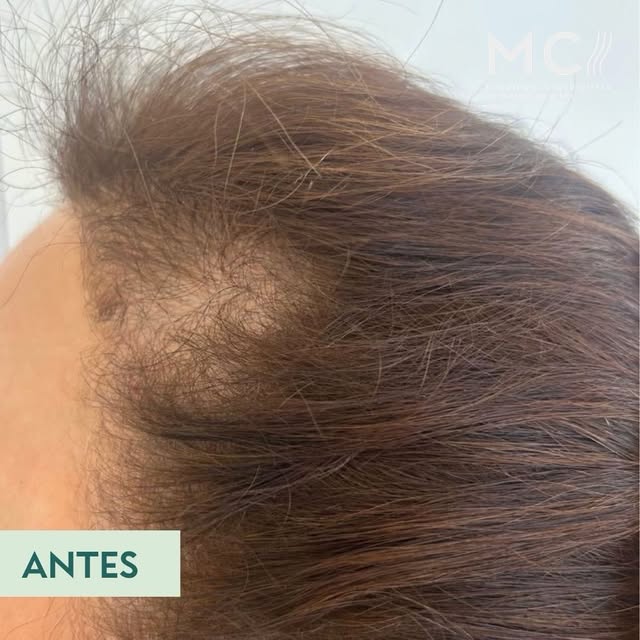 Resultado de tratamiento Tricoterapéutico. 

Objetivos del tratamiento:

1.- Prevenir la alopecia, n