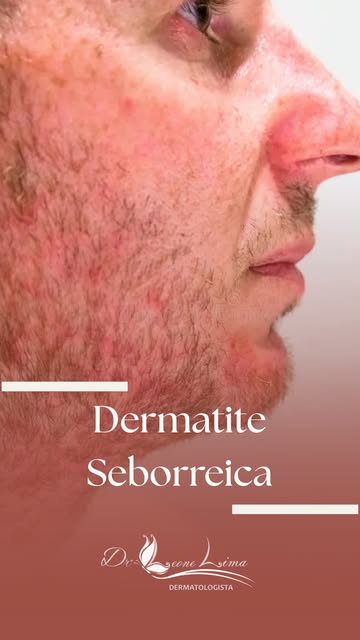 A dermatite seborreica NÃO é causada pela falta de higiene. 🚫

Esse é um dos mitos mais repetidos (