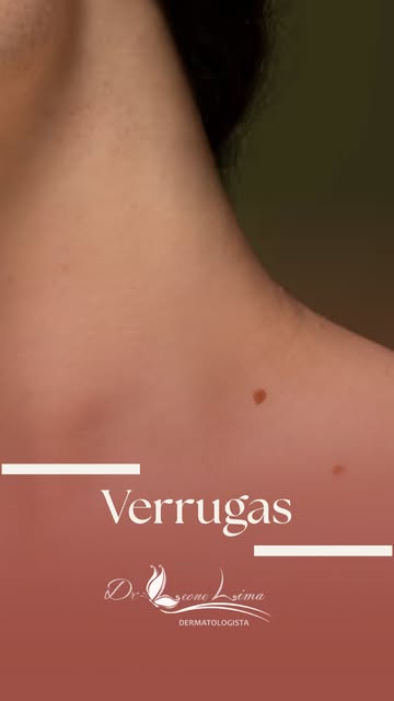 Verrugas incomodam, na aparência e na autoestima. 
Elas são causadas pelo HPV cutâneo e, mesmo sendo