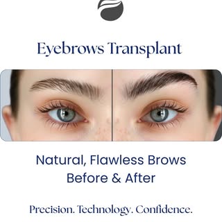 Transform Your Brows with State-of-the-Art Eyebrow Transplant Technology.
Our expert surgeons use ad