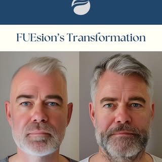 From Thinning to Thriving, These Real Before & After Results Speak for Themselves. 
Your Dream Hair 