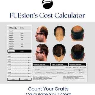 FUEsion's Online Cost Calculator
Use our Cost Calculator to see how many grafts you’ll need and what