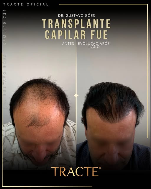 👊🏼👀 Dr.Gustavo Góes é Médico CRM 140.721, Dermatologista há 15 anos e Especialista em Tricologia 