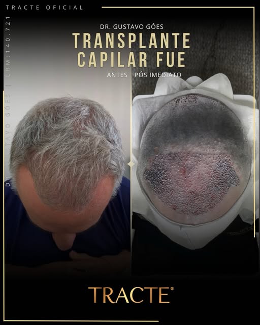👊🏼👀 Dr.Gustavo Góes é Médico CRM 140.721, Dermatologista há 15 anos e Especialista em Tricologia 