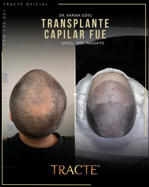 👁️👉🏻 Resultado do Transplante Capilar FUE; realizado por @drakarinapinheirogoes , Médica  CRM 135