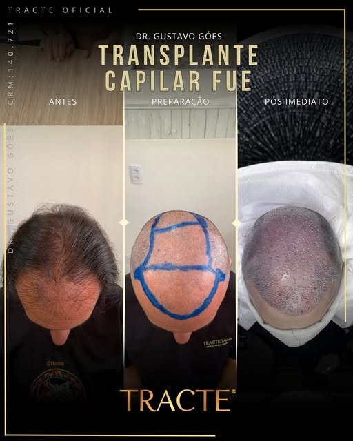 👊🏼👀 Dr.Gustavo Góes é Médico CRM 140.721, Dermatologista há 15 anos e Especialista em Tricologia 