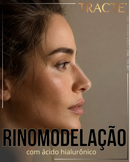 👃✨ Rinomodelação é um procedimento que utiliza ácido hialurônico para harmonizar o formato do nariz