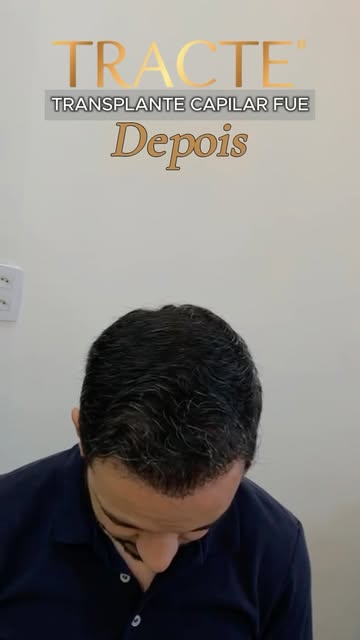 👊🏼👀 Dr.Gustavo Góes é Médico CRM 140.721, Dermatologista há 15 anos e Especialista em Tricologia 