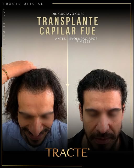 🫵🏼👉🏻 Apenas 7 Meses !!!

👊🏼👀 Dr.Gustavo Góes é Médico CRM 140.721, Dermatologista há 15 anos 