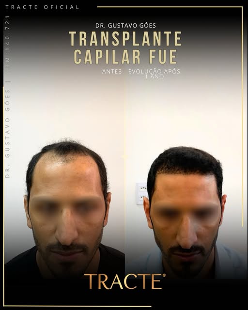 👊🏼👀 Dr.Gustavo Góes é Médico CRM 140.721, Dermatologista há 15 anos e Especialista em Tricologia 