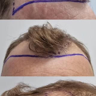 Same guy. Different confidence!

#HairTransplantUK #FUEhairtransplant
