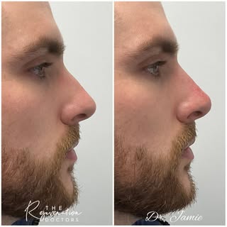 Small tweaks 👌🏻 

We do things differently.

#nonsurgicalnosejob #nonsurgicalrhinoplasty