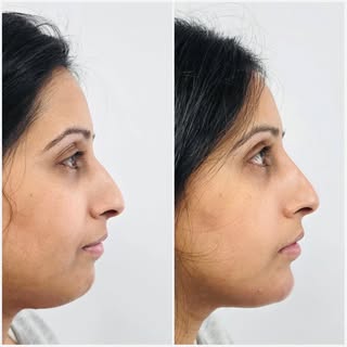 Chin and Nose filler go hand-in-hand when it comes to profile balancing.

Its not yet perfect. To ge