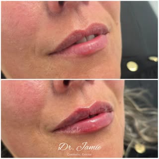 It's never JUST a ml of filler...

It's art 👌🏻

This result was created using @teoxane_uk RHA 2 fi