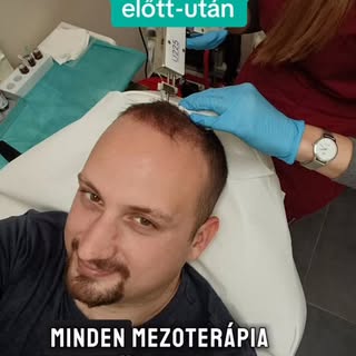 Tavaszra szeretnél a hajadnak egy nagy vitaminbombát? Egyik előnye, hogy sem rákészülést, sem utóápo