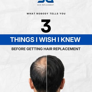 I really wished I knew this earlier…
Before getting a hair replacement, many people think it’s only 