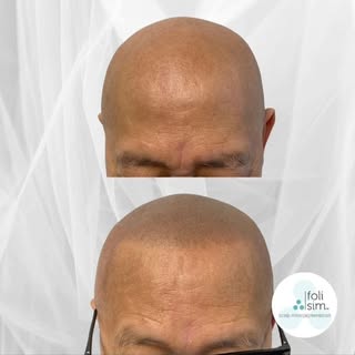 Awesome results with Scalp Micropigmentation (SMP) from our Perth artist Tara.

SMP is a non-invasiv