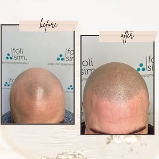 ✨ Confidence Restored with SMP! ✨

Looking for a solution to hair loss or thinning? Scalp Micropigme