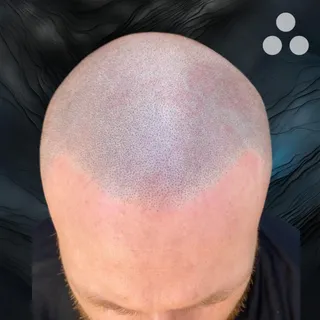 Our client didn't like the high recession along his hair line and was already buzz cutting his hair 