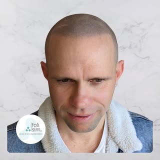 Amazing transformation with Scalp Micropigmentation (SMP) by Tara.

Our client requested to keep his