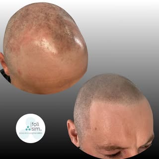 Amazing transformation for one or our Perth clients by Tara.

*Please note there is some post treatm