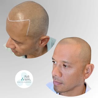 Precision in every follicle. 🔎

​The secret to great Scalp Micropigmentation? It’s undetectable.

​