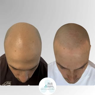 ​Check out this incredible Scalp Micropigmentation (SMP) transformation!

​This before-and-after sho
