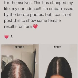 Amazing transformation with Scalp Micropigmentation by @tarascrivener.at.folisim

We are always so g