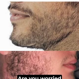 Re-design your look with Hair, Beard & Eyebrow transplant. Consult Hairtronics Now. Andheri-70307005
