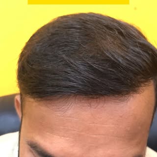 Checkout Review of Hairtornics, Thane.
Call or WhatsApp Now for Free Consultation: +91-7718851415

#