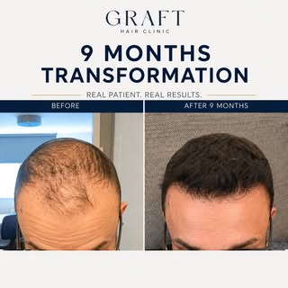 The transformation speaks for itself.

From visible thinning across the frontal scalp and hairline t