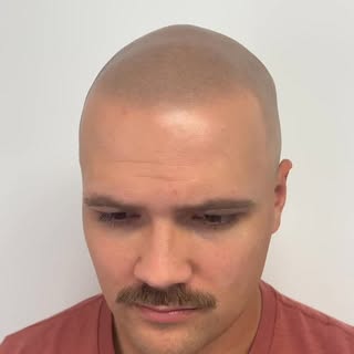 Scalp Micropigmentation is life changing with guaranteed results! Look younger! Restore your confide