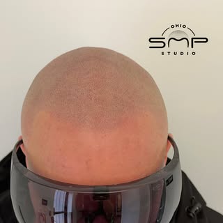 OHIO’s #1 SMP ARTIST💯 Scalp Micropigmentation is life changing with guaranteed results! Look younge