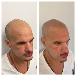 OHIO’s #1 SMP ARTIST💯 Scalp Micropigmentation is life changing with guaranteed results! Look younge