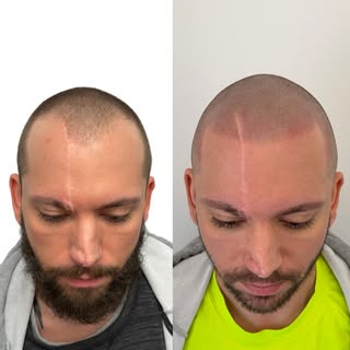 OHIO’s #1 SMP ARTIST💯 Scalp Micropigmentation is life changing with guaranteed results! Look younge