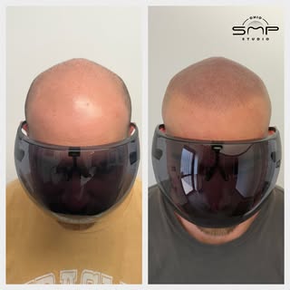 OHIO’s #1 SMP ARTIST💯 Scalp Micropigmentation is life changing with guaranteed results! Look younge