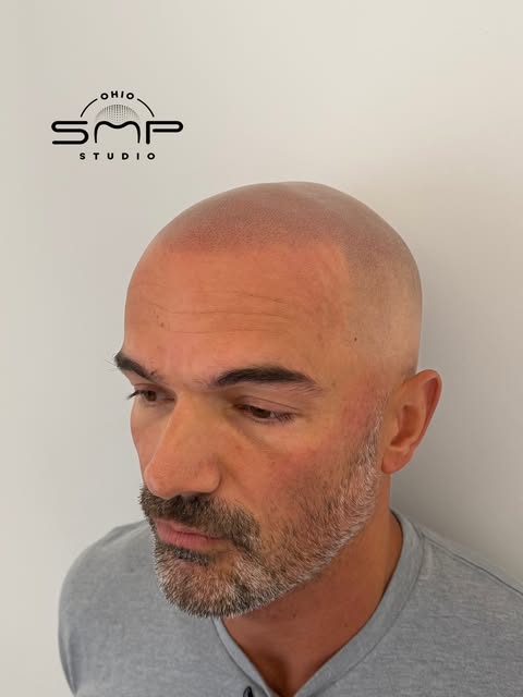 OHIO’s #1 SMP ARTIST💯 Scalp Micropigmentation is life changing with guaranteed results! Look younge