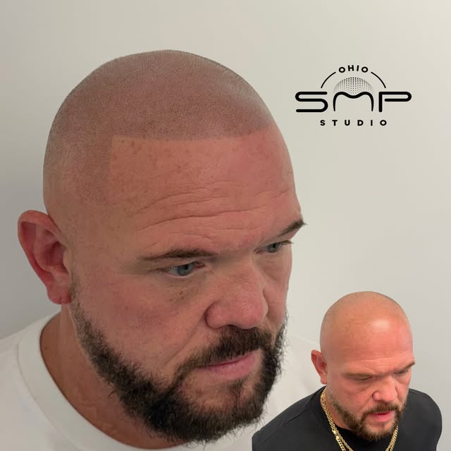 Hard Hairline…  OHIO’s #1 SMP ARTIST💯 Scalp Micropigmentation is life changing with guaranteed resu