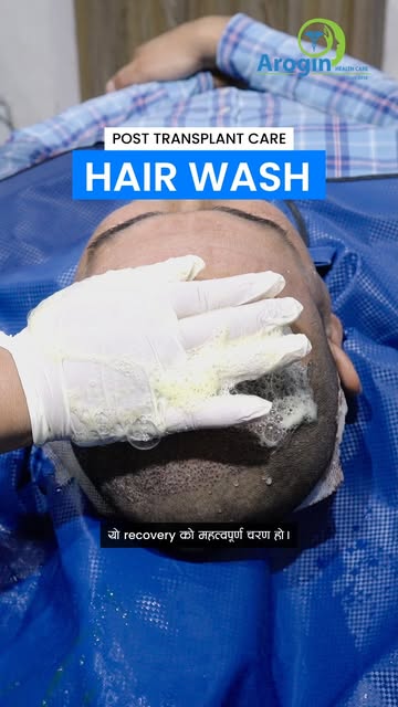 हेयर ट्रान्सप्लान्टपछि सहि तरिकाले hair wash नयाँ कपालको सफलताका लागि अति आवश्यक छ! 🚿✨

किन आवश्यक 