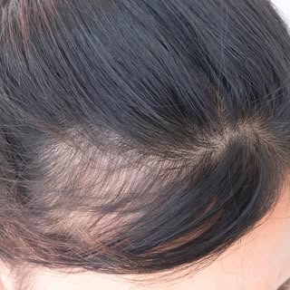 Enjoy your ponytail stress free! If you don’t like your hairline when it’s pulled back, we can help 