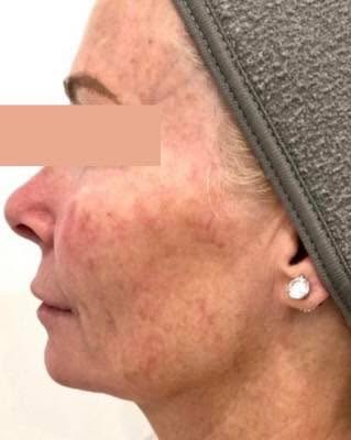 Before and after Cool Peel. 

Based on 2023 American Society for Dermatologic Surgery Consumer Surve