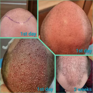 Progress of hair transplantation after 2 weeks !!
Πρόοδος της μεταμόσχευσης μαλλιών μετά από 2 εβδομ