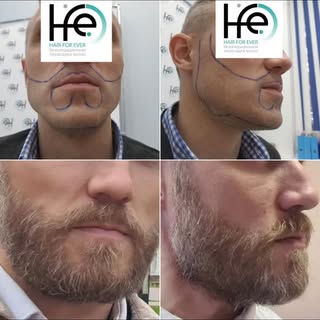 #hairtreatment #hairloss #fuemethod #hairlosstreatment #hairlosssolutions #hairrestoration