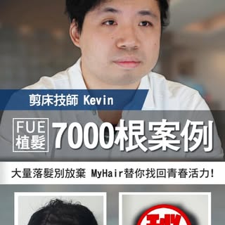 巨量植髮案例 | FUE植髮7000根，大量落髮別放棄，MyHair生髮植鬍診所，幫你找回夢想中的茂密頭髮  #林士棋醫師 #myhair生髮植鬍診所

植髮立即詢問 👉https://lin.ee