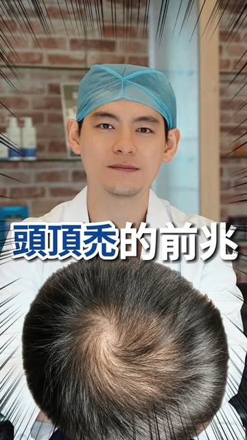 頭頂禿的前兆有哪些？
高雄MyHair生髮植鬍診所院長 - 林士棋醫師

#頭頂禿 #雄性禿 #林士棋醫師 #生髮 #生髮水 #生髮慕斯  #植髮 #植髮手術 #植髮診所 #myhair生髮植鬍診所 