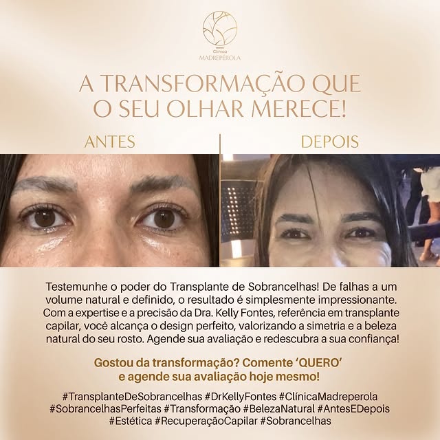 Testemunhe o poder do Transplante de Sobrancelhas. De falhas a um volume natural e definitivo, o res