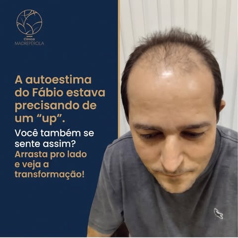 Após o transplante capilar, o Fábio recuperou muito mais do que os cabelos: recuperou a autoestima, 