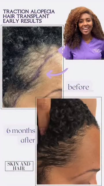 Hair transplant for traction Alopecia is always so rewarding! 

To book a consultation:
☎️: 913-232-