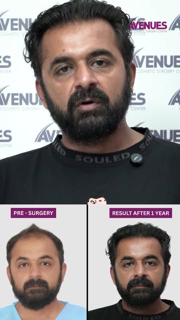 1 Year FUE Hair Transplant Result 🤯

One year after his Refined FUE hair transplant, the hairline h